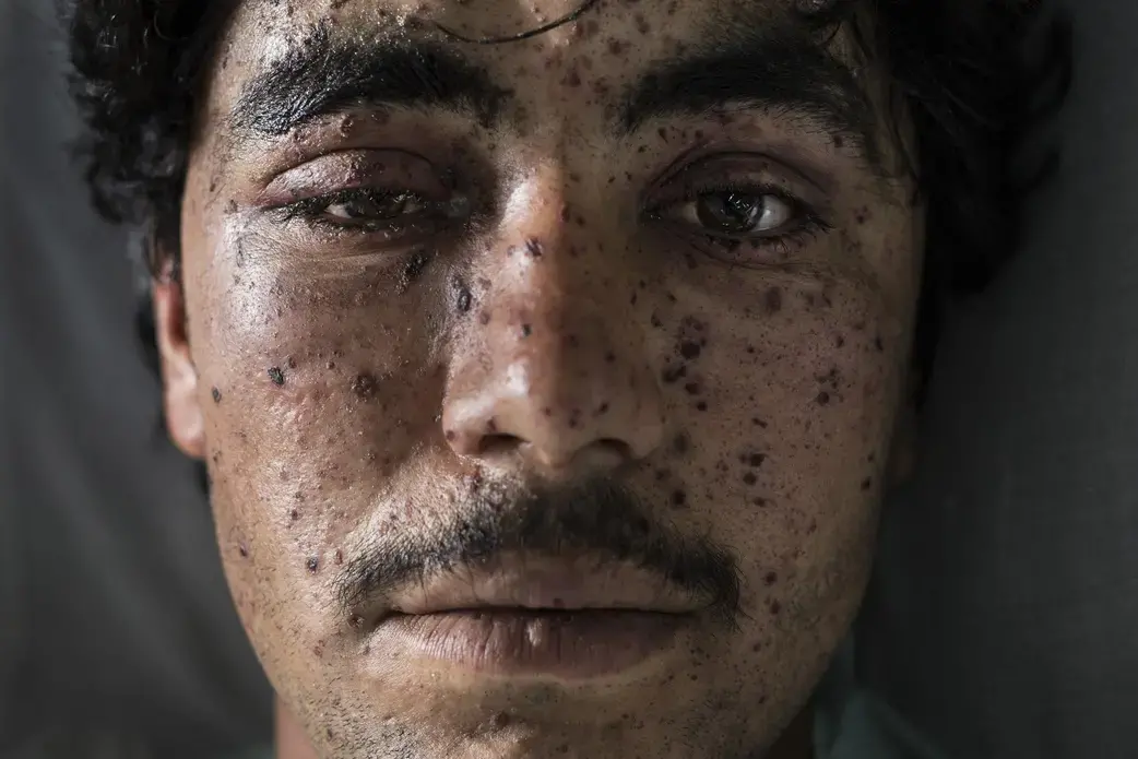 Kharim Ahmad,22, suffered shrapnel wounds on his face and the loss of a leg from fighting in Sangin. He was being treated at the Emergency hospital in Lashkar Gah on March 25. Image by Paula Bronstein. Afghanistan, 2016.