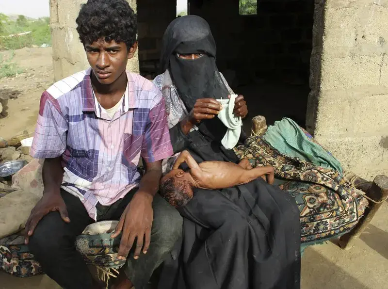 Severely malnourished infant Zahra is changed by her mother, right, in the village of al-Mashradah, Aslam, Hajjah. Image by Hammadi Issa for AP. Yemen, 2018.