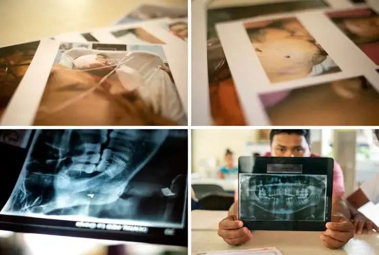 Walter Sanchez Reyes was shot in the face while driving a bus in Tegucigalpa, Honduras. The bullet entered the right side of his face and exited on the left side of his jaw. A fragment of the bullet remains in his jaw and is visible in his X-ray. Images by Miguel Gutierrez Jr. Mexico, 2019.